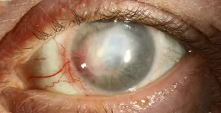 Herpes Ocular